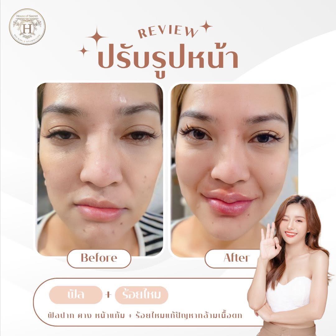 รีวิว ปรับรูปหน้า