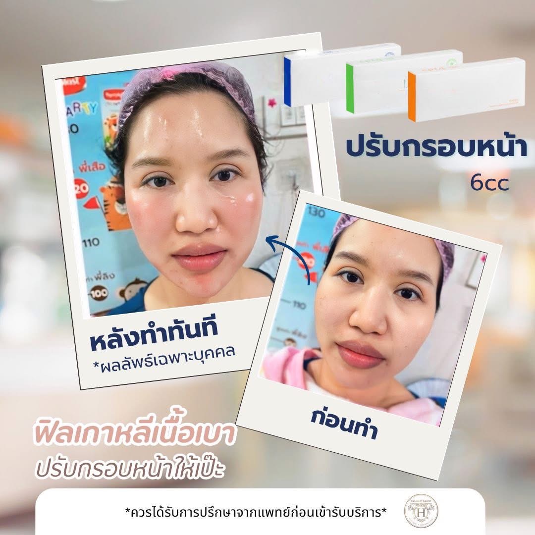 รีวิวปรับกรอบหน้า