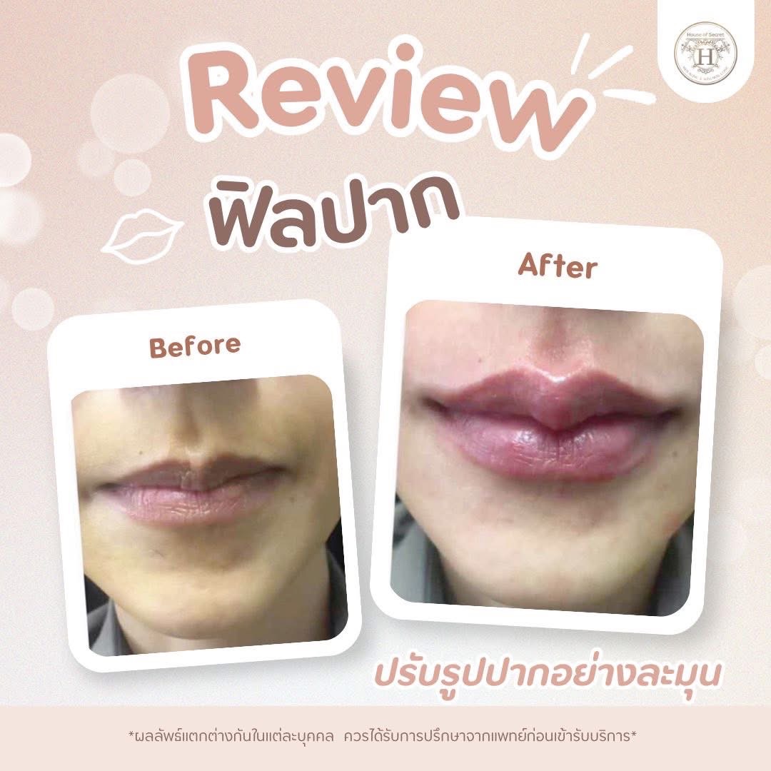 รีวิว ปรับรูปปาก