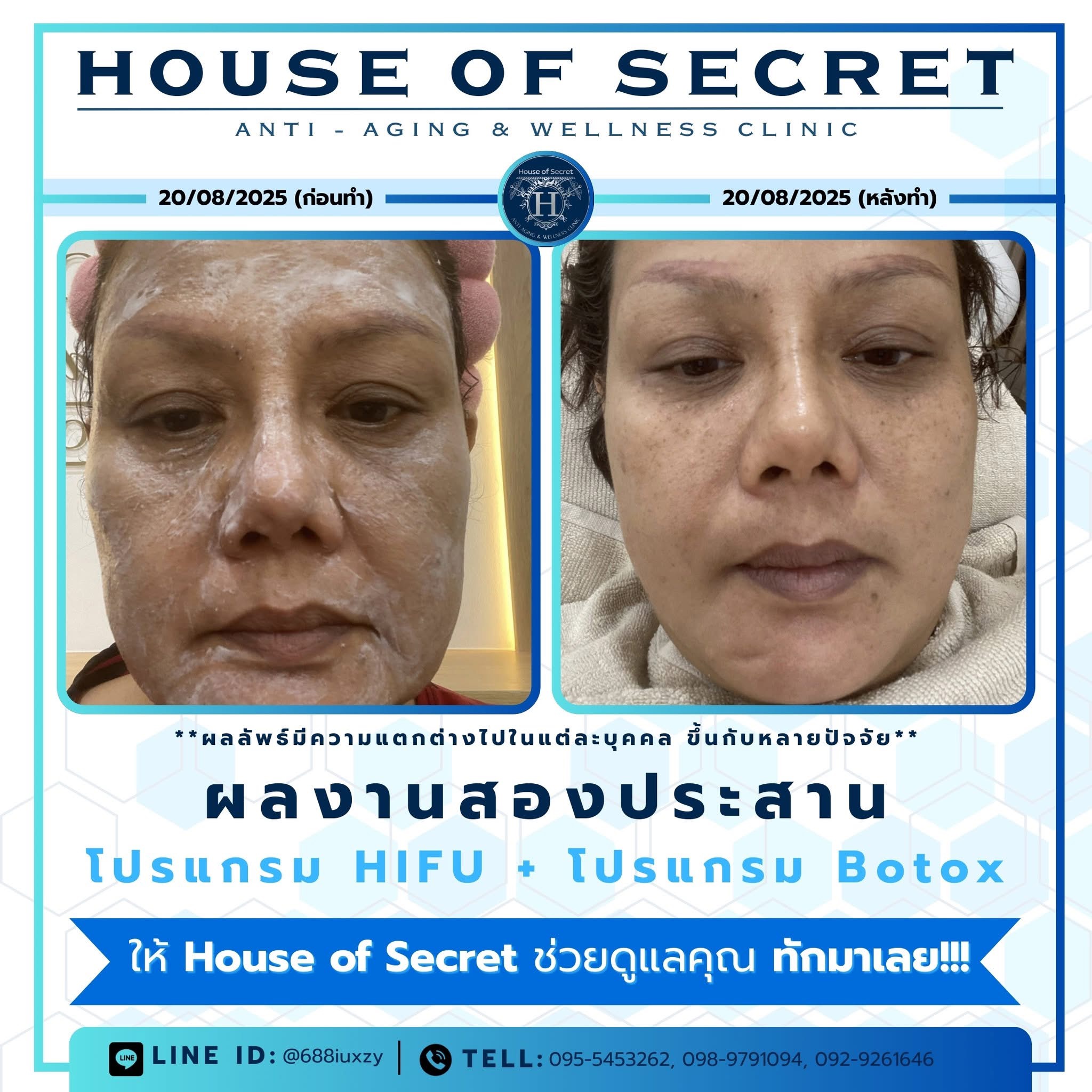 รีวิว hifu+botox