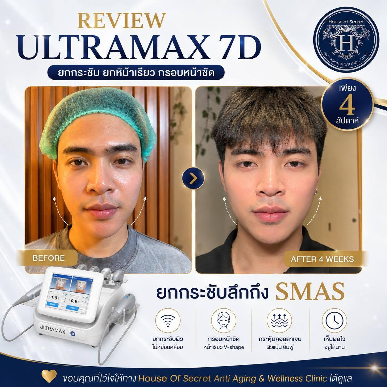 รีวิวคุณผู้ชายแบบจิ้งๆ กรอบหน้าเป๊ะ หน้าไม่ยก ไม่เรียว ไม่ปล่อยให้กลับบ้านค่ะ