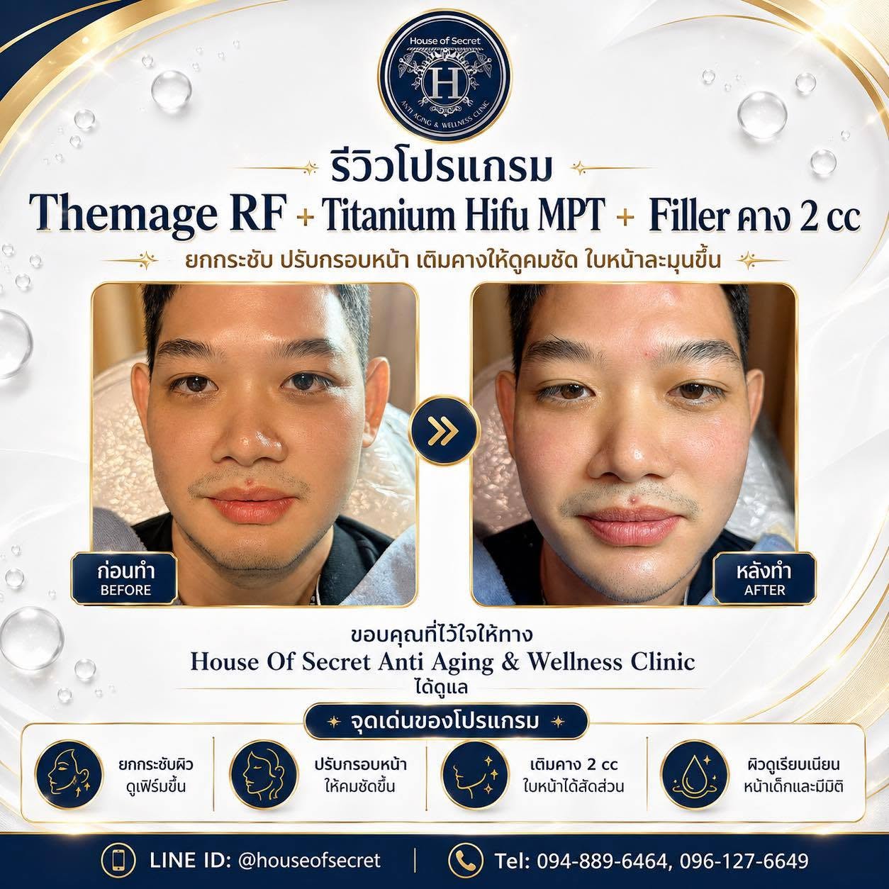 รีวิวโปรแกรม Thermage RF + Titanium Hifu MPT + Filler คาง 2 CC