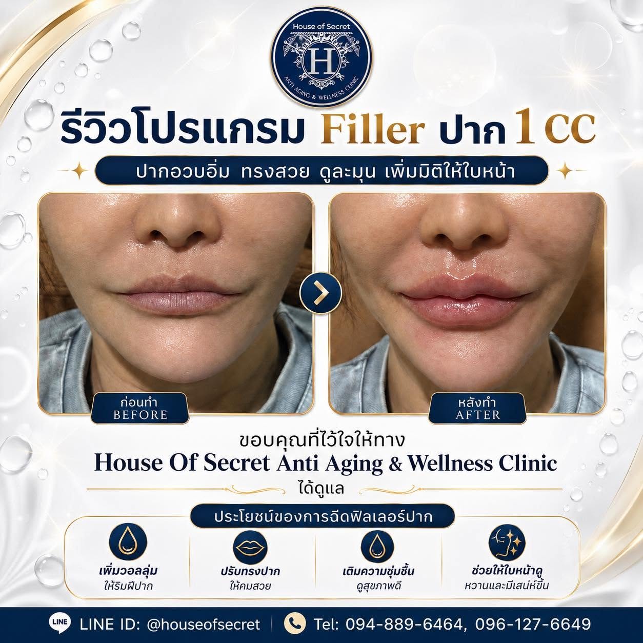 รีวิวโปรแกรม Filler ปาก 1 CC เติมวอลลุ่มให้ริมฝีปากดูอวบอิ่ม ทรงสวย ดูละมุนขึ้นแบบมีมิติ