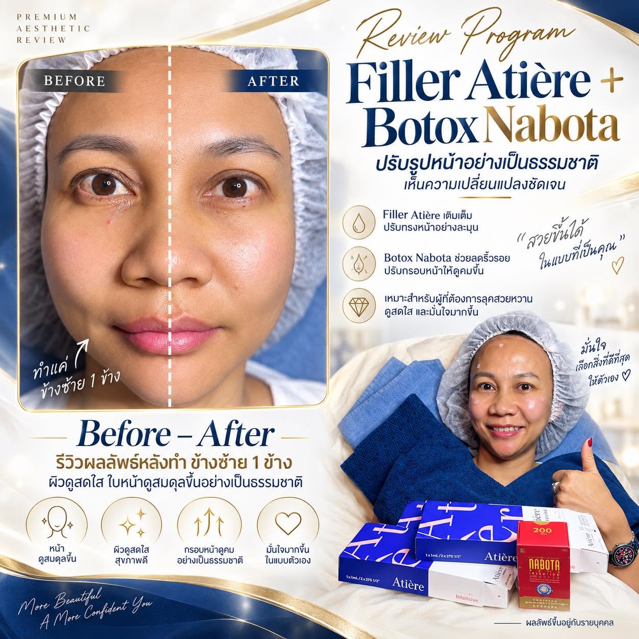 รีวิวโปรแกรม Filler Atière + Botox Nabota ปรับองค์รวมของใบหน้าให้ดูละมุน สดใส และมีมิติมากขึ้นแบบเป็นธรรมชาติ